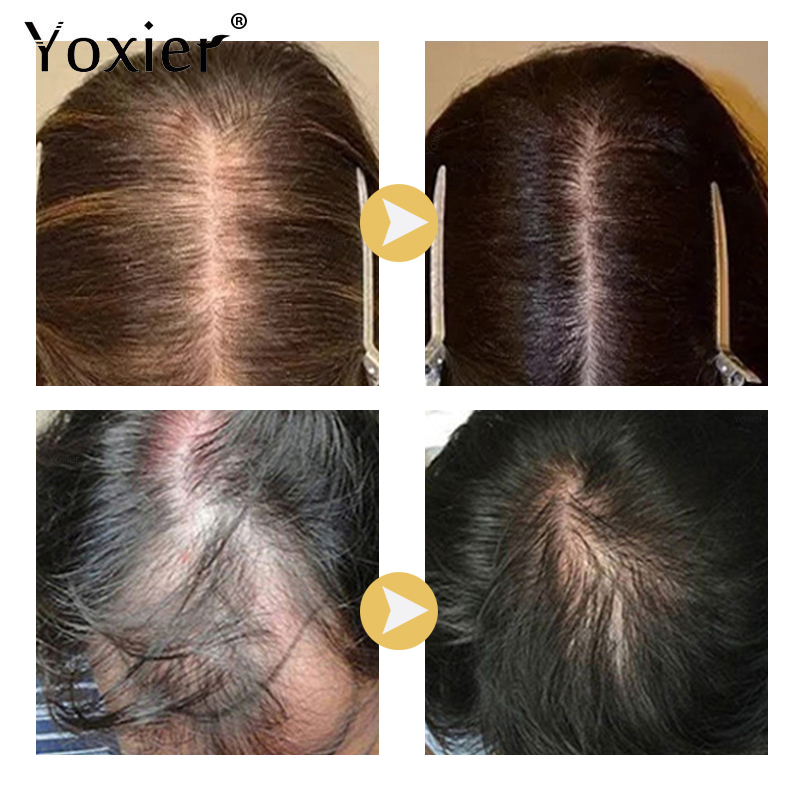 Intensive Wachstum Serum Verhi – Hair Care Serum Bewertung und Preis